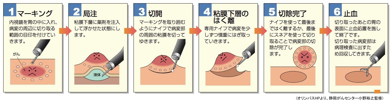 内視鏡手術 静岡がんセンター