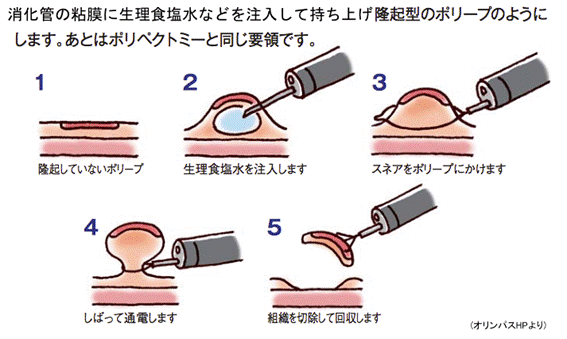 が 視 大腸 ん 鏡 手術 内