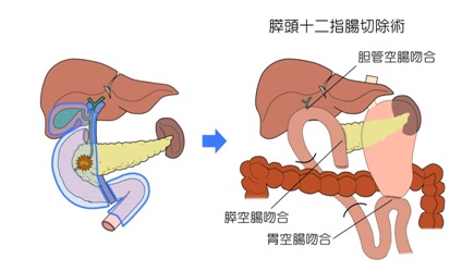 「膵頭十二指腸切除」の画像検索結果