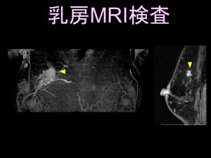 乳房ＭＲＩ検査